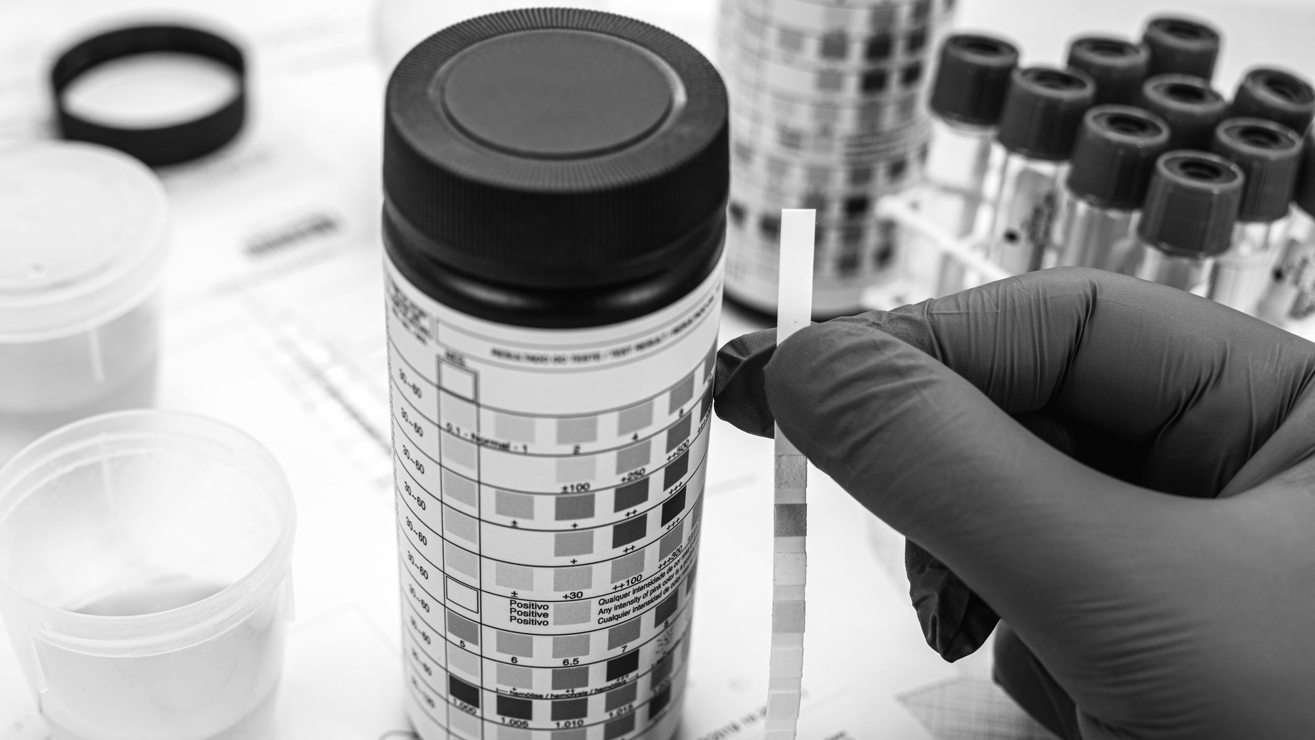 urine test, made with a vial of Urinalysis Reagent Strip used fo Laboruntersuchungen in der Hausarztpraxis Aichtal-Neuenhaus